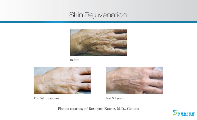 Skin Rejuvenation Montreal Photos