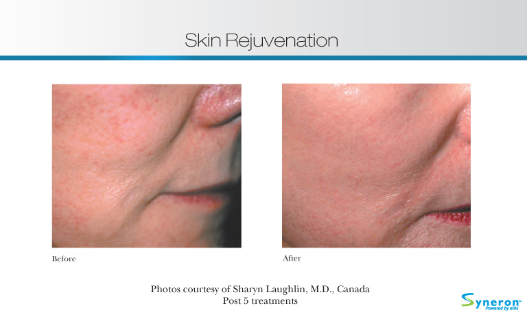 Montreal Skin Rejuvenation