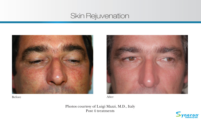 Skin Rejuvenation Montreal Photos