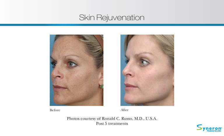 Skin Rejuvenation Montreal