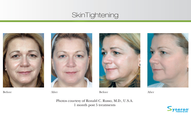 IPL Laser Skin Tightening